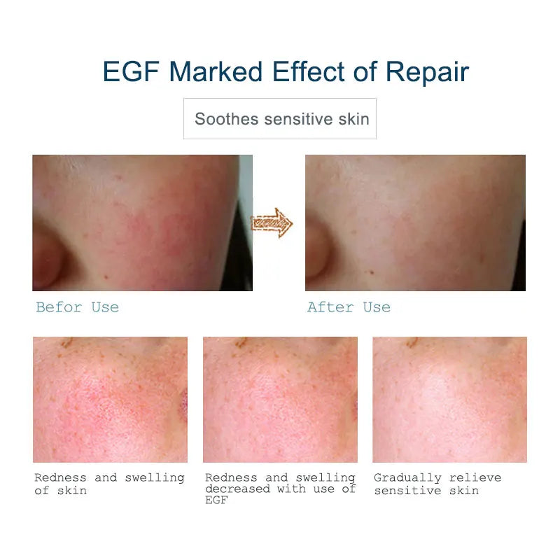 Buy 3 Get 1 Gift ARTISCARE EGF Serum Acne Treatment Blackhead Skin Care Anti Wrinkle Whitening Moisturizing Repair Face Essence