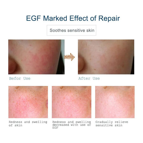 Buy 3 Get 1 Gift ARTISCARE EGF Serum Acne Treatment Blackhead Skin Care Anti Wrinkle Whitening Moisturizing Repair Face Essence