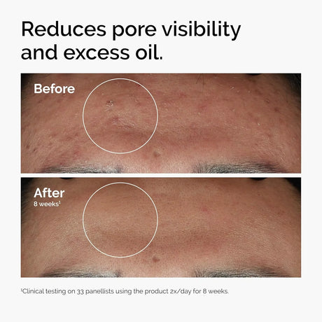 10% Niacinamide 1% Zinc Face Serum 30ml, Oil Control Pore Minimizer, Anti-Acne Dark Spot, Gentle Skin Care for All Skin Types