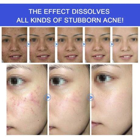 Herbal Acne Removal Face Cream Clears Pimple Scar Black Dots Gel Acne Treatment Shrink Pore Skin Whitening Lightening Ointment