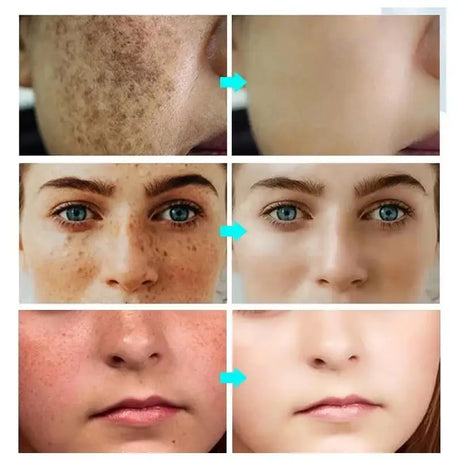 Powerful Spot-removing Whitening Freckles Cream Remove Melasma Dark Spots Fade Pigmentation Acne Moisturizing Brighten Skin Care