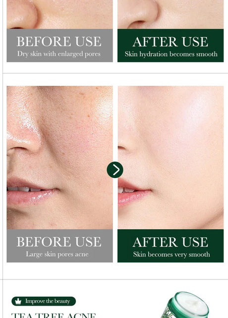 SADOER Tea Tree Acne Removing Face Cream Anti Acne Hydrating Oil Control Moisturizing Facial Creams Face Skin Care Products