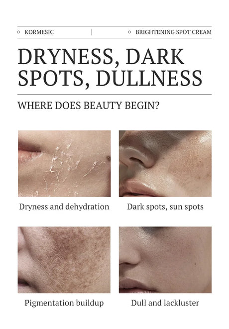 Dark Spots Removal Cream Facial Whitening Freckle Acne Mark Pigmentation Removal Melanin Skin Correction Brighten Care Products