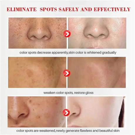 Powerful Spot-Removing Whiten Cream Brighten Skin Fast Eliminates Melanin Pigmentation Melasma Dark Spots Korean Face Skin Care