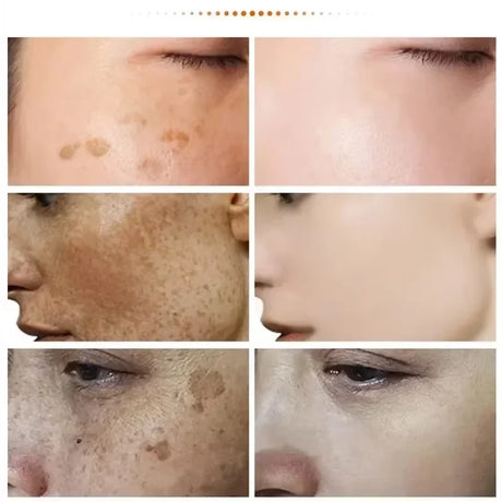 Powerful Spot-removing Whitening Freckles Cream Remove Melasma Dark Spots Fade Pigmentation Acne Moisturizing Brighten Skin Care