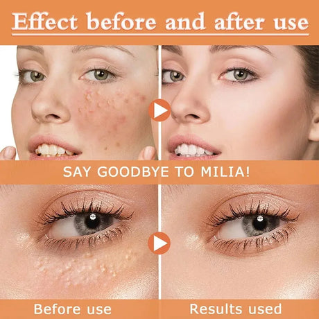 Remove Eye Fat Particles Serum Milia Treatment Products Anti Puffiness Anti Inflammatory Repair Skin Barrier Korean Skin Care