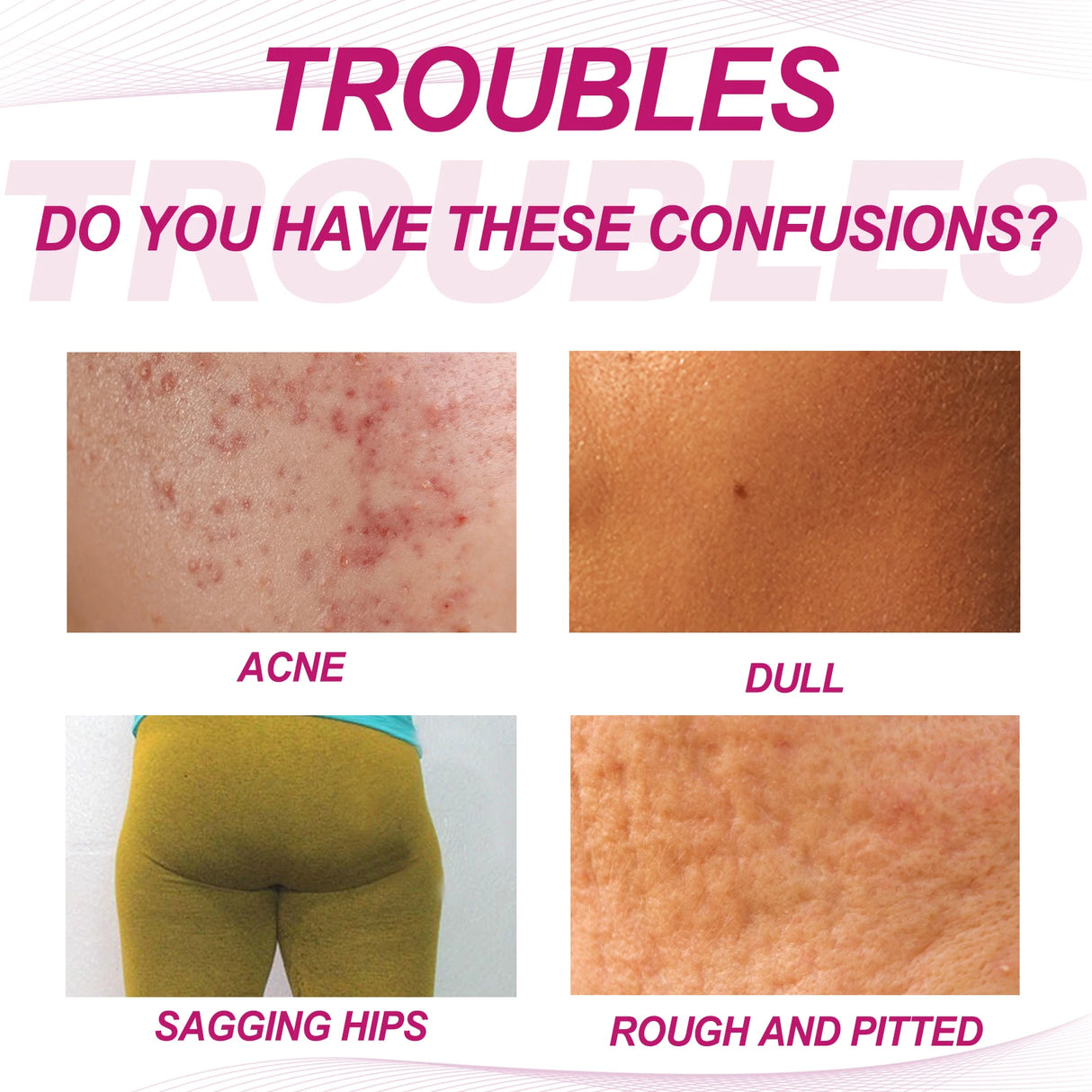 Butt Thigh Acne Cream Remove Pimples Moisturizing Clarifying Brightening Smoothing Skin Care Thigh Acne Removal Cream