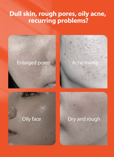 Herbal Acne Treatment Cream Anti Acne Face Cream Pimple Removal Spots Oil Control Shrink Pores Moisturizing Skin Care Cream