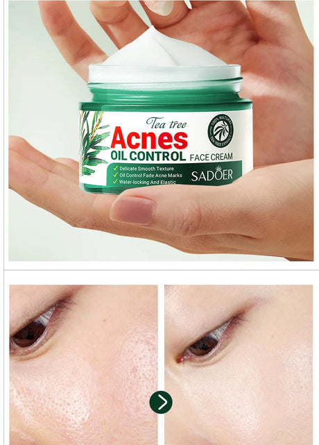 SADOER Tea Tree Acne Removing Face Cream Anti Acne Hydrating Oil Control Moisturizing Facial Creams Face Skin Care Products
