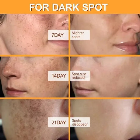 Whitening Freckles Face Cream Removal Melasma Dark Spots Corrector Lighten Melanin Pigmentation Brighten Anti-Aging Beauty Care