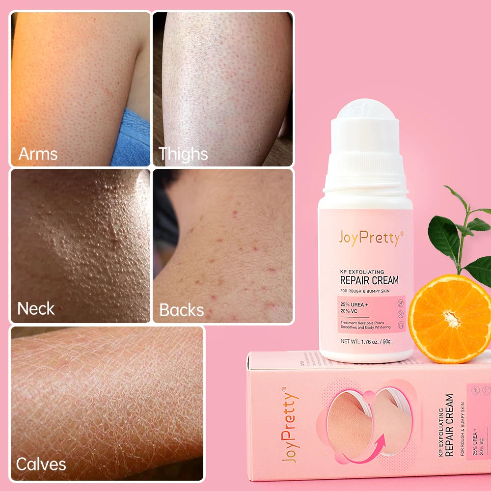 Chicken Skin Removal Cream Body Curing Keratosis Follicle Pore Spot Dull Treatment Whitening Moisturizing Body Care JoyPretty