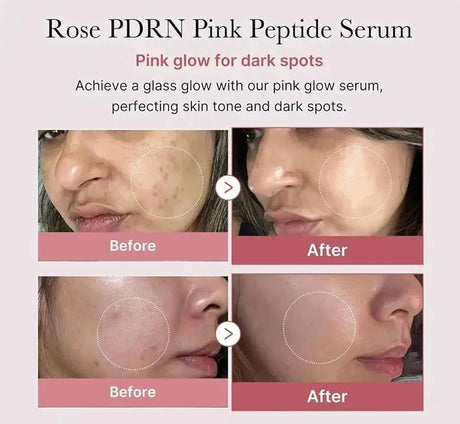 Niacinamide Dark Spot Remove Serum Face Freckle Melanin Correcting Moisturizing Brightening Anti Pigmentation Repair Skin Care