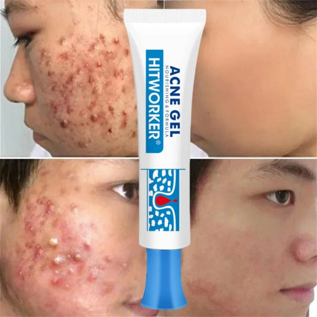 Salicylic Acid Acne Removal Cream Anti-Acne Repair Redness Pimple Spots Deep Cleaning Pore Oil Control Moisturizing Skin Care