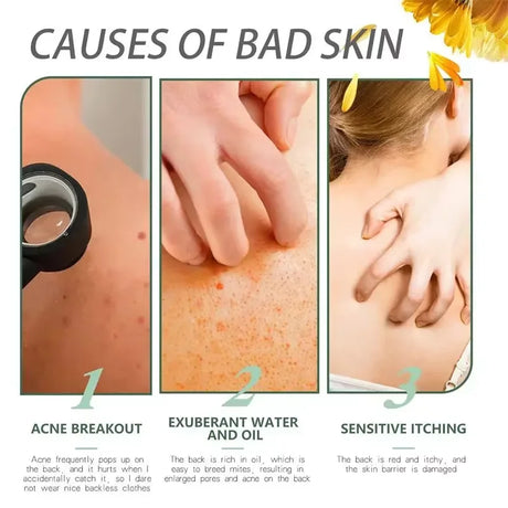 Salicylic Acid Acne Treatment Cream Repair Pimple Spots Deep Cleaning Pore Shrinking Anti-acne Oil Control Moisturizer Skin Care
