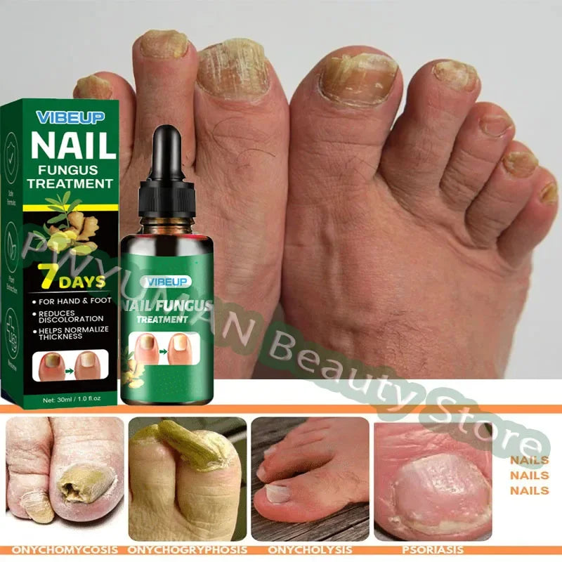 7 Days Nail Fungus Treatment Serum Ginger Anti-infective Paronychia Onychomycosis Toe Foot Nail Fungal Repair Gel Hand Foot Care