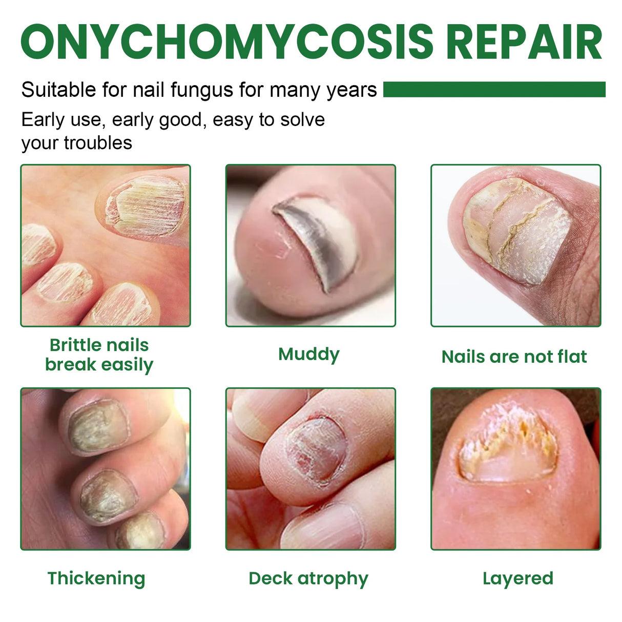 7 Days Nail Fungus Treatment Serum Ginger Anti-infective Paronychia Onychomycosis Toe Foot Nail Fungal Repair Gel Hand Foot Care