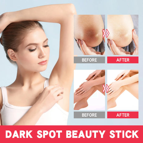 Lightening Body Cream Remove Dark Spots Melanin Bleaching Elbow Armpit Leg Knee Hips Thigh Moisturizing Whitening Underarm Stick