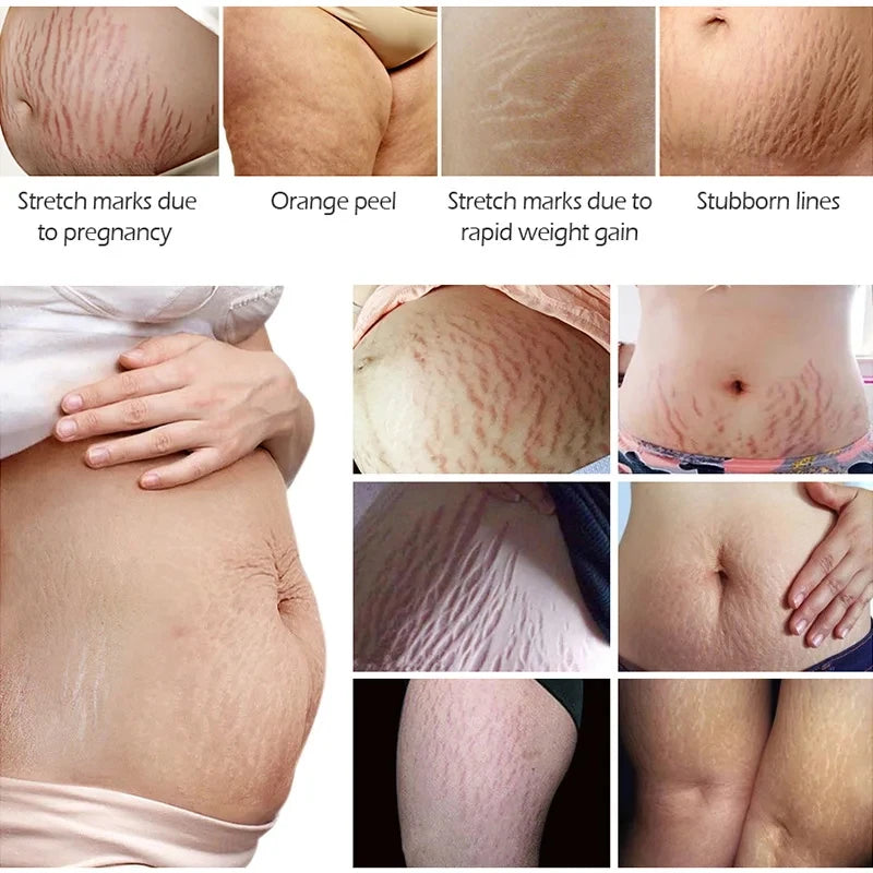 Snail Removes Stretch Mark Cream To Remove Postpartum Obesity Pregnant Women Repair Anti-Aging Anti-Winkles Firming Body Cream