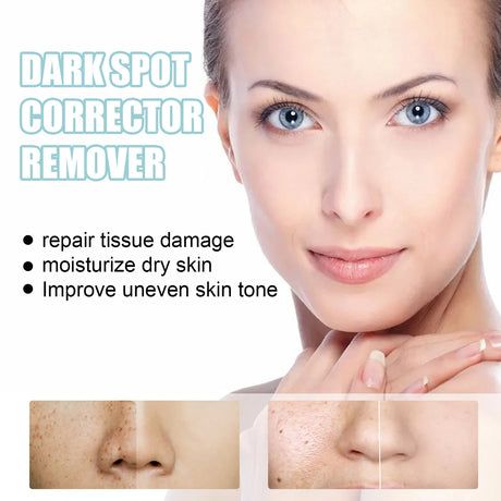Freckle Whitening Cream Nicotinamide Fade Dark Spot Blemish Acne Mark Brightening Lightening Pigmentation Correction Cream