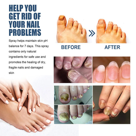 South Moon Foot Spray Anti Smell Remove Toenail Fungal Paronychia Onychomycosis Care Deodorant Antiperspirant Nail Repair Spray