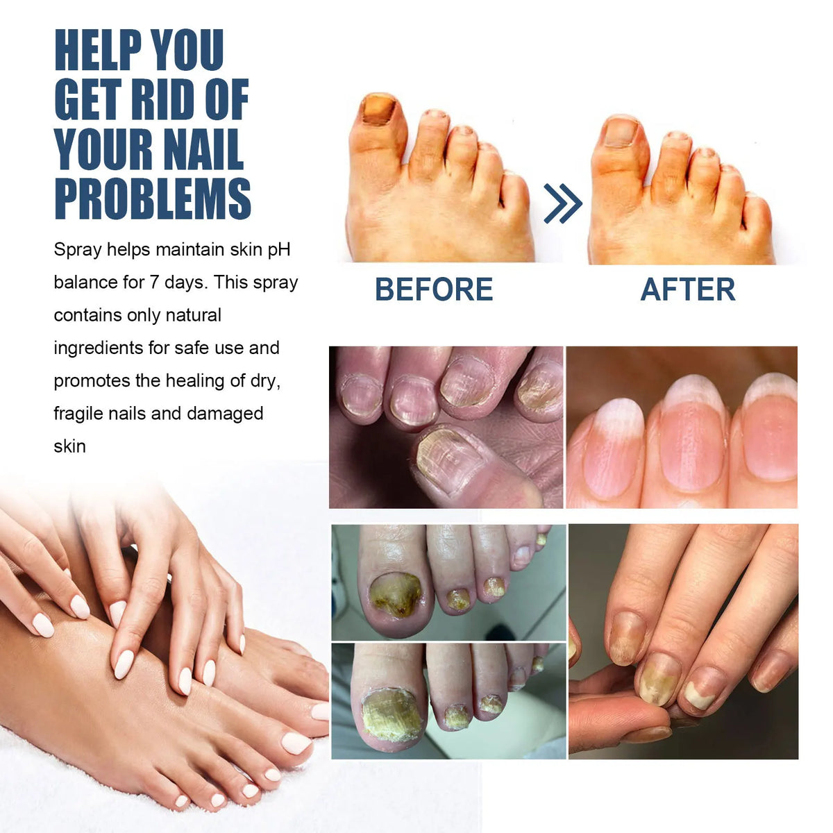 South Moon Foot Spray Anti Smell Remove Toenail Fungal Paronychia Onychomycosis Care Deodorant Antiperspirant Nail Repair Spray