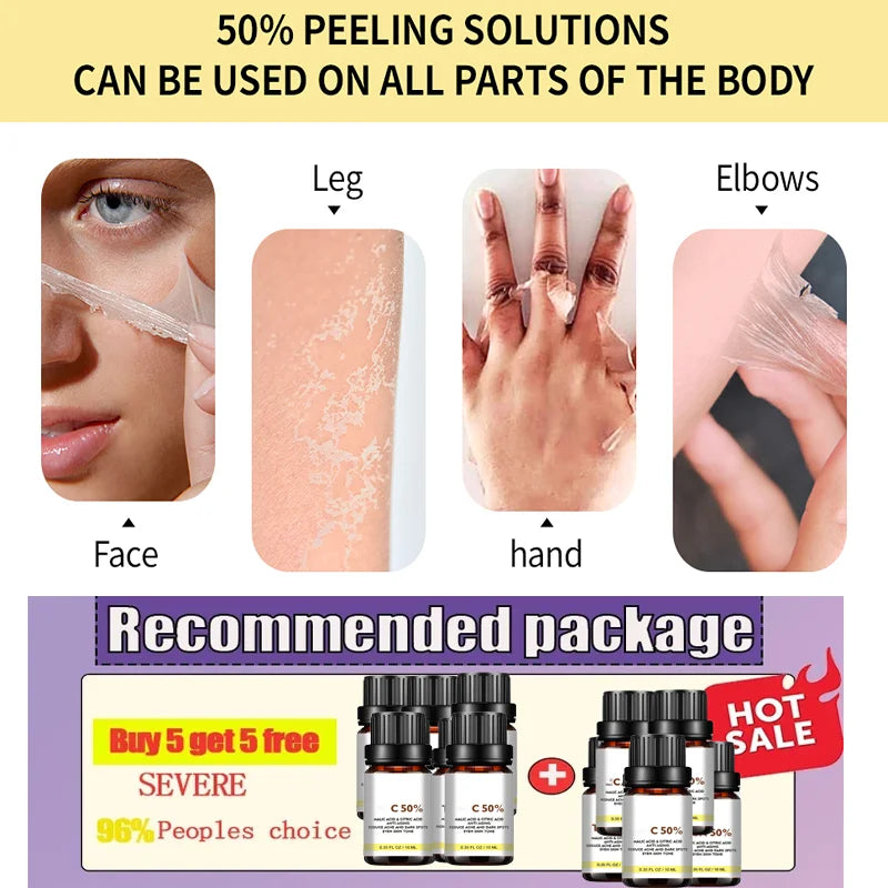 High Quality 50% Chemical Peel Acid Skin Superforce Pigmentation Lightening Melanin Acne Treatment Remove Scar