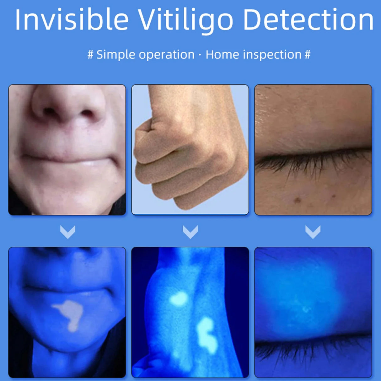 NEW Professional Dermatoscope Skin Medical Magnifier Detection Woods Lamp UVA Lamp For Vitiligo Detection