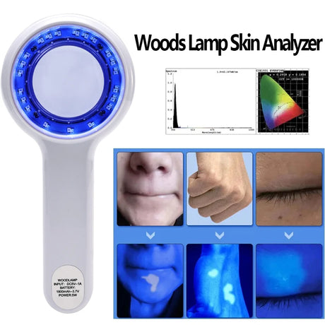 NEW Professional Dermatoscope Skin Medical Magnifier Detection Woods Lamp UVA Lamp For Vitiligo Detection