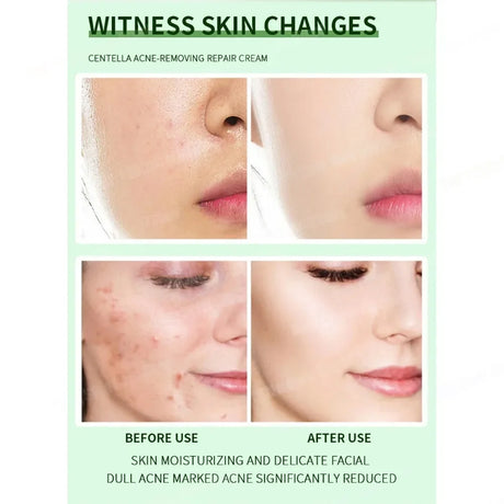Anti-Acne Cream Effectively Removes Skin Nodules Pustules Cysts Papules Blackheads Men And Women Acne Skin Care Essence Cream