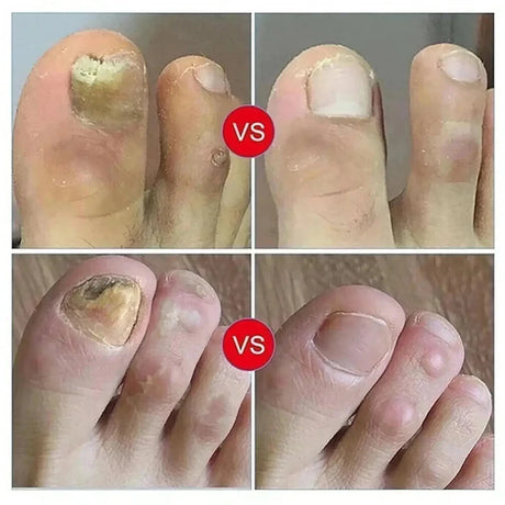 7 Days Nail Fungus Treatment Serum Ginger Anti-infective Paronychia Onychomycosis Toe Foot Nail Fungal Repair Gel Hand Foot Care