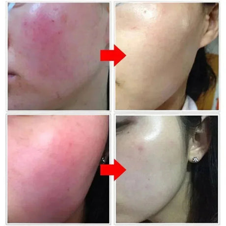 B5 Repair Facial Redness Cream Instant Spider Vein Remove Sensitive Skin Sooth Anti Redness Rosacea Treat Lotion Korean Cosmetic