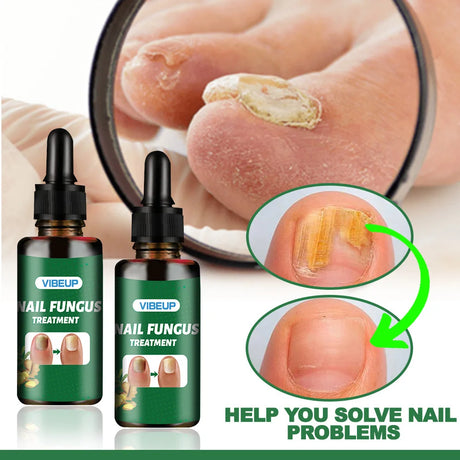 7 Days Nail Fungus Treatment Serum Ginger Anti-infective Paronychia Onychomycosis Toe Foot Nail Fungal Repair Gel Hand Foot Care