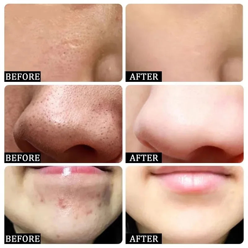 Remove Large Pores Serum Salicylic Acid Facial Pore Shrinking Tightening Pore Minimizing Firming Smooth Essence Korean Skin Care