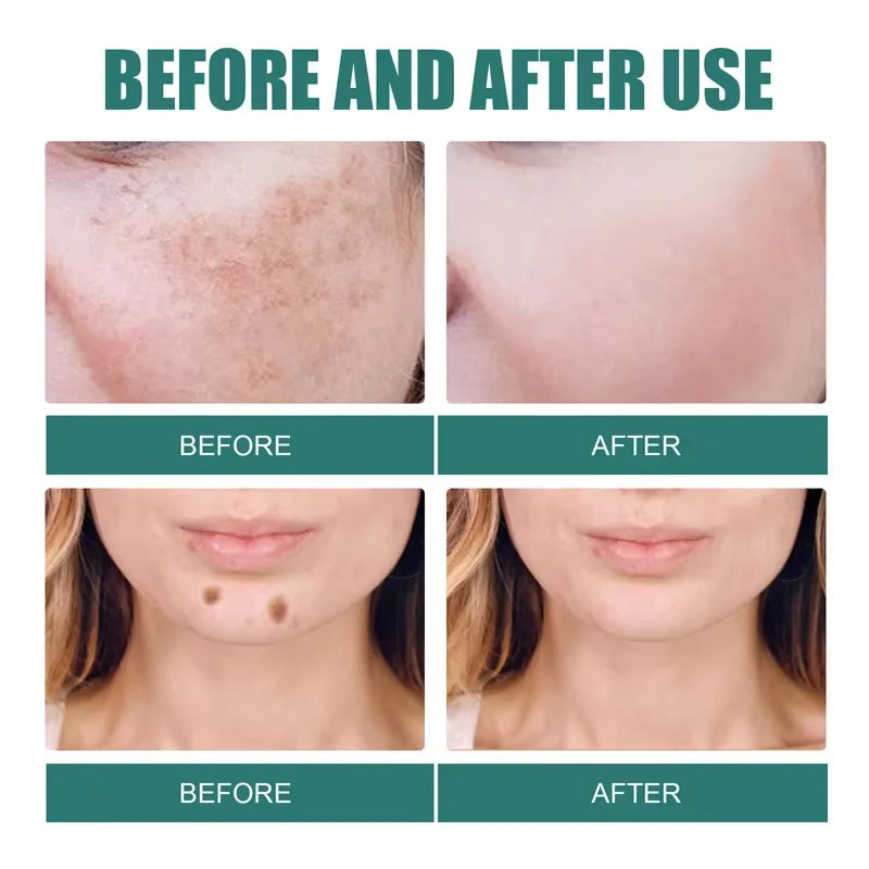 Powerful Spot-removing Whitening Freckles Cream Remove Melasma Dark Spots Fade Pigmentation Acne Moisturizing Brighten Skin Care