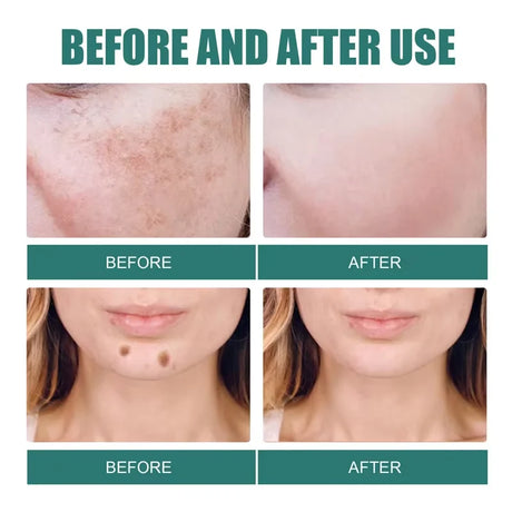 Powerful Spot-removing Whitening Freckles Cream Remove Melasma Dark Spots Fade Pigmentation Acne Moisturizing Brighten Skin Care