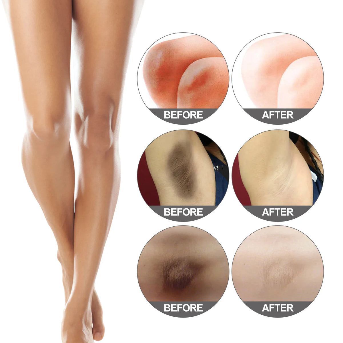Whitening Cream Private Parts Underarm Bleaching Serum Whiten Butt Knee Brighten Inner Thigh Intimate Parts Dark Remove Melanin