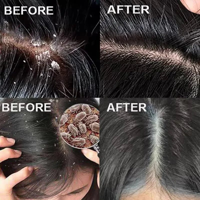 Fast Anti Exfoliating Scrub Remove Dandruff Anti Itching Treatment Seborrheic Scalp Oil Control Repair Scalp Beauty Health Care