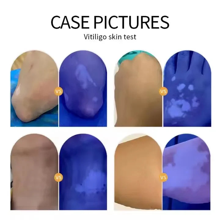 NEW Professional Dermatoscope Skin Medical Magnifier Detection Woods Lamp UVA Lamp For Vitiligo Detection
