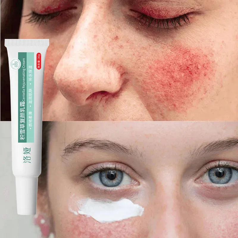 Instant Facial Redness Repair Cream Soothing Red Blood Rosacea Treatment Improve Sensitive Skin Anti Redness Skin Care Cosmetics