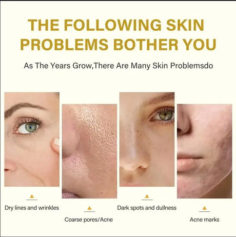 High Quality 50% Chemical Peel Acid Skin Superforce Pigmentation Lightening Melanin Acne Treatment Remove Scar