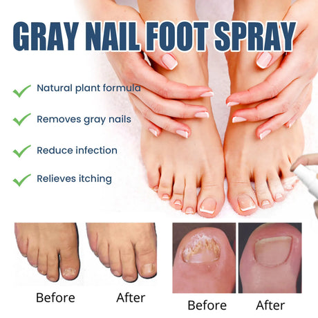 South Moon Foot Spray Anti Smell Remove Toenail Fungal Paronychia Onychomycosis Care Deodorant Antiperspirant Nail Repair Spray