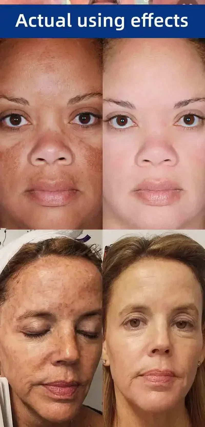 Dark Spot Remover for Face Removing Freckle Chloasma Senile Plaques Sunburn Cyasma Chorioplaque Freckle Cream