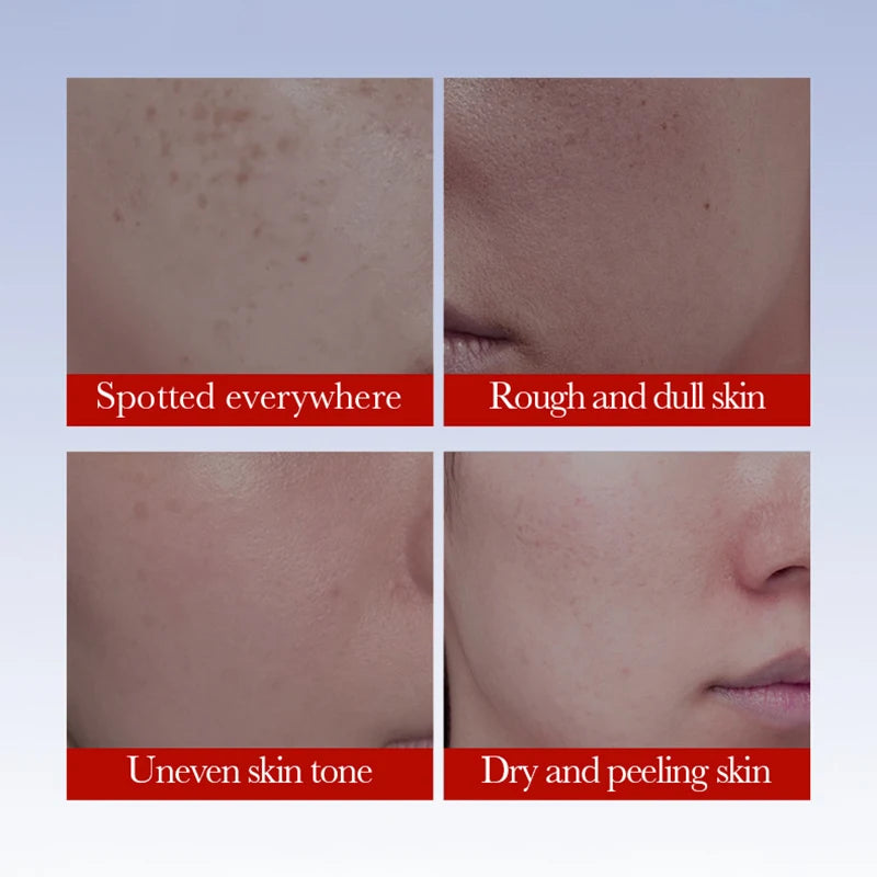 SADOER Anti Freckle Cream Face Brightening Creams Spot Removing Anti-aging Moisturizing Freckles Removal Facial Cream Skin Care