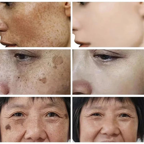 Powerful Spot-Removing Whiten Cream Brighten Skin Fast Eliminates Melanin Pigmentation Melasma Dark Spots Korean Face Skin Care