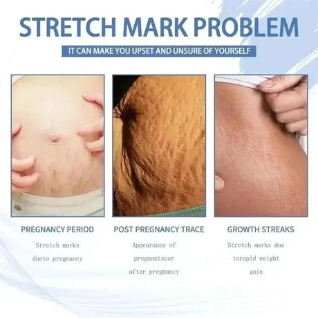 Cream For Pregnancy Stretch Marks Removal Eliminate Red White Old Stretch Marks 2025