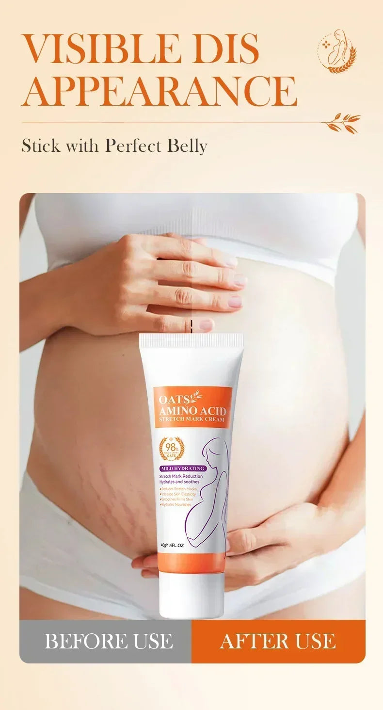 Cream For Pregnancy Stretch Marks Removal Eliminate Red White Old Stretch Marks 2025