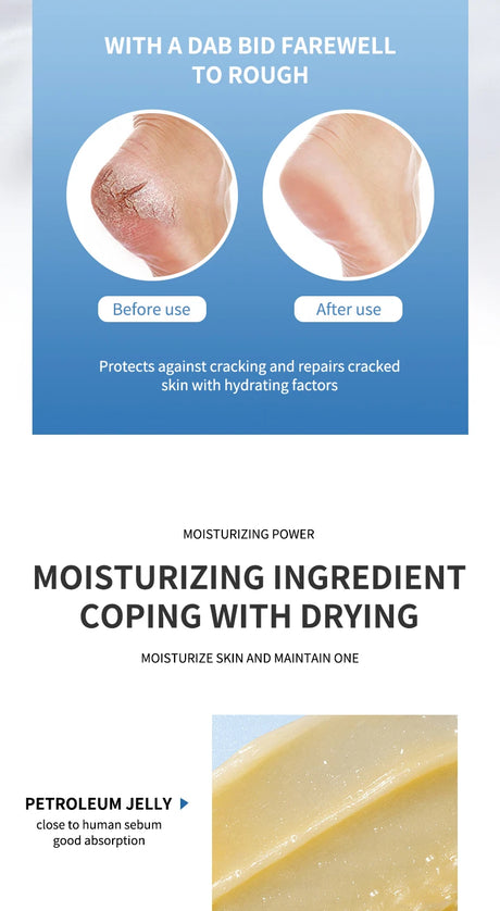 Anti Crack Foot Cream For Dry And Cracked Feet And Heels, Moisturizing Dry Feet And Heels, Preventing Your Feet From Cracking