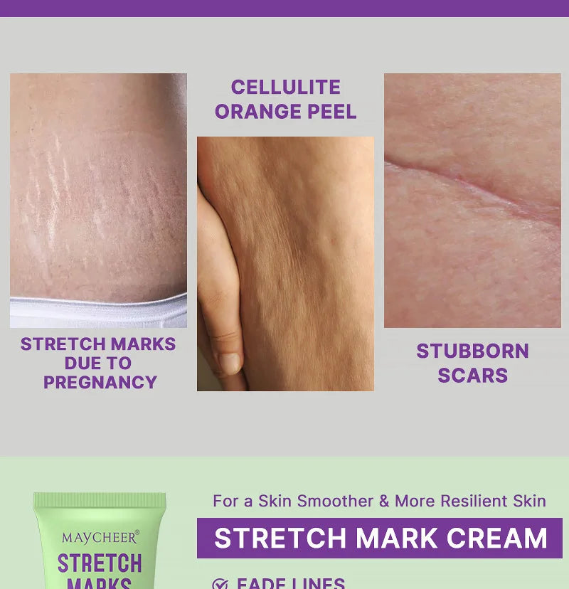 Stretch Marks Repair Cream Fade Lines Improve Duliness Tightness Long-lasting Moisturizing Smooth Enhance Elasticity Body Care