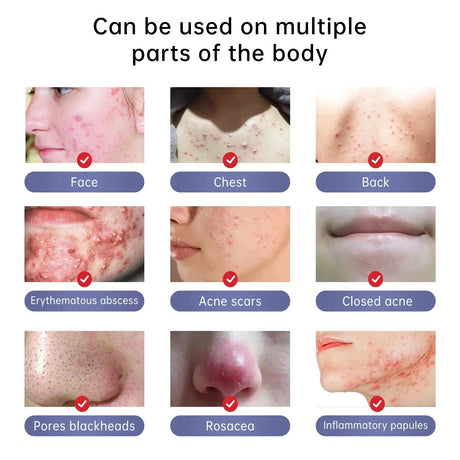 Herbal Acne Removal Face Cream Clears Pimple Scar Black Dots Gel Acne Treatment Shrink Pore Skin Whitening Lightening Ointment