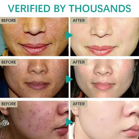Powerful Spot-removing Whitening Freckles Cream Remove Melasma Dark Spots Fade Pigmentation Acne Moisturizing Brighten Skin Care